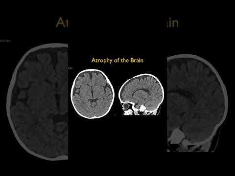 Atrophy of the Brain