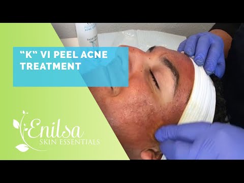 "K" VI Peel Acne Treatment (Full Face View)