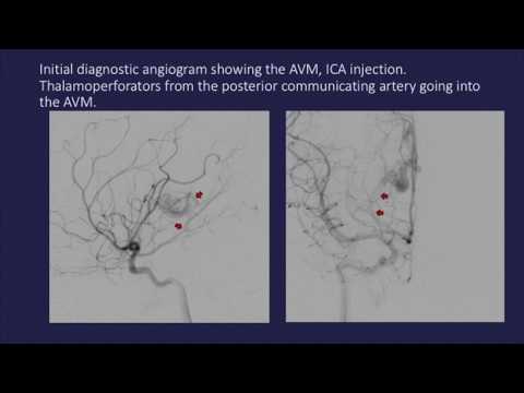 Transvenous embolization of thalamic arteriovenous malformation under transient cardiac standstill