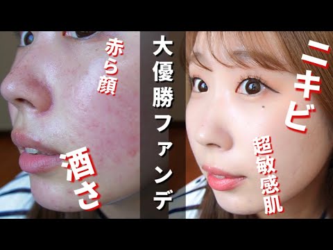 【超敏感肌】ニキビ/赤み/酒さ で悩む私の最強ベースメイク（今回はニキビを隠すメイクです !!☺︎ ）