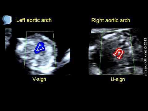 Right aortic arch: ultrasound at 11-13 weeks