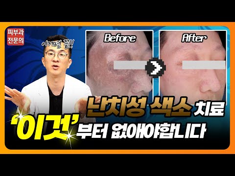 오타모반 / 밀크커피반점 / 릴흑피증 등 다양한 색소질환😨 다시 깨끗한 얼굴로 돌아올 수 있습니다✨✨ #오타모반 #릴흑피증 #색소질환