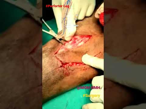 #Perforator of leg,#Surgery