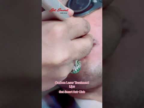 Carbon Laser Treatment Lips #getsmarthairclub #beauty #viralvideo