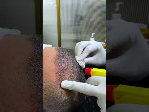 First Shampoo Headwash after Hair Transplant | Cara Clinic