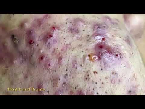 Ance Remove - Blackheads Removal - Best Pimple Popping (Part 02)