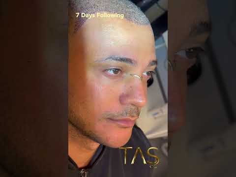 Chin Augmentation, Neck Liposuction, Rhinoplasty & Hair Transplant by Dr. TAS