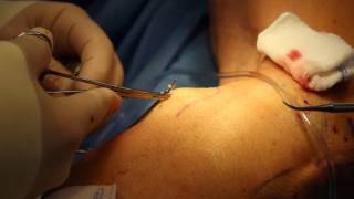 Microstab Phlebectomy // Varicose Vein Removal