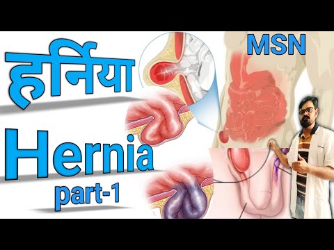 #हर्निया/what is Hernia/#Types of hernia/#हर्निया क्या है/#कैसे होता है हर्निया?/#MSN Class/science