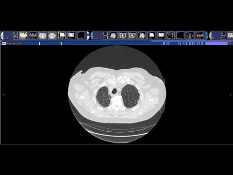 How to read a high-resolution chest CT