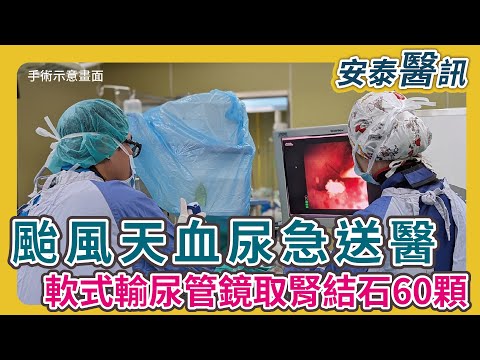 颱風天血尿送醫 軟式輸尿管鏡取腎結石60顆#軟式輸尿管鏡