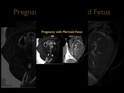 Pregnancy with Mermaid Fetus