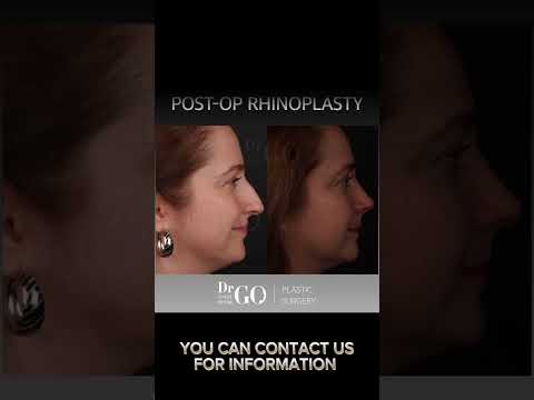 Before and after rhinoplasty - Dr Guncel Ozturk