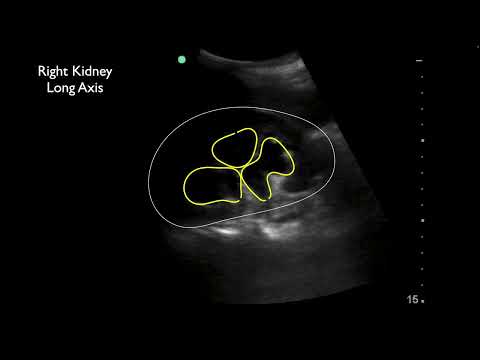 Urinary Retention with Bilateral Severe Hydronephrosis