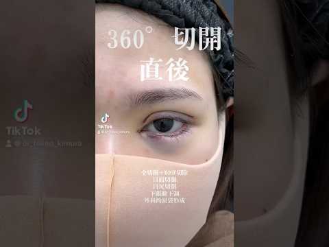 【二重整形】360°切開 術直後