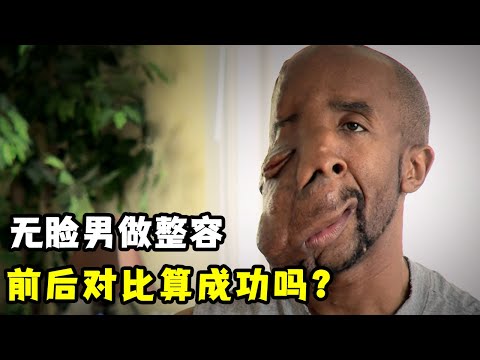 34岁无脸男做整容，前后对比算成功吗？好心人捐款30万不留名！纪录片