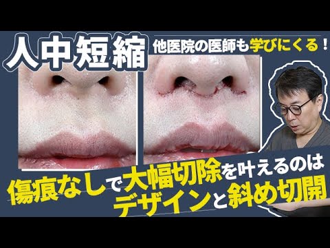 【人中短縮】傷痕なしの大幅切除は、デザイン・斜め切開・土手の利用がポイントです！他院の医師が学びにくる哲院長の人中短縮のこだわりを徹底解剖