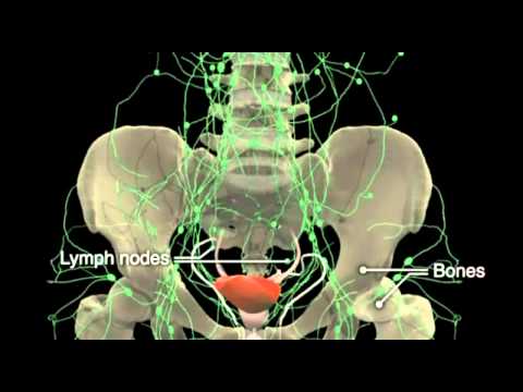 How Prostate Cancer Develops in Your Prostate Gland