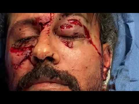 REAL PATIENTS REAL STORIES: *GRAPHIC* DOG BITE TO FACE TRAUMA SURGERY & POSTOP FACIAL DEFECT ANATOMY