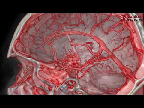 Endoscopic endonasal surgery for giant pediatric craniopharyngioma