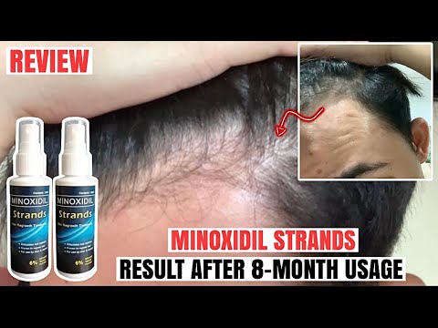 Minoxidil Strands Review: Result AFTER 8 months | Don’t STOP using it‼️