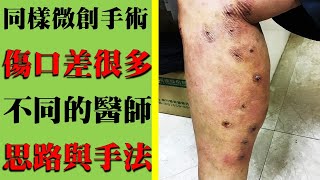 同樣都是微創手術，為什麼傷口差很大？｜許原彰醫師：台北，台中，高雄，台南，新竹，桃園，靜脈曲張專家