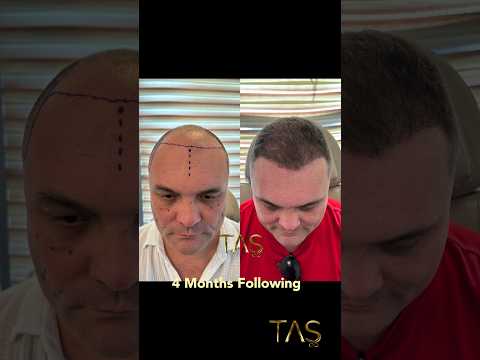 #hairtransplant 4 Months Following 🚀#hairtransplantation #hairtransplantcenter #profdrsuleymantas