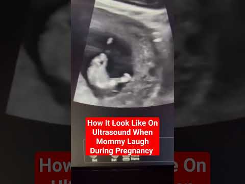 how it looks like in the womb during ultrasound #babyultrasound #ultrasoundscans