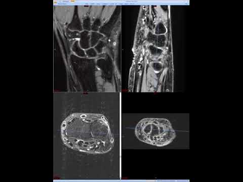 Wrist MRI (Approach to MSK MRI Series)