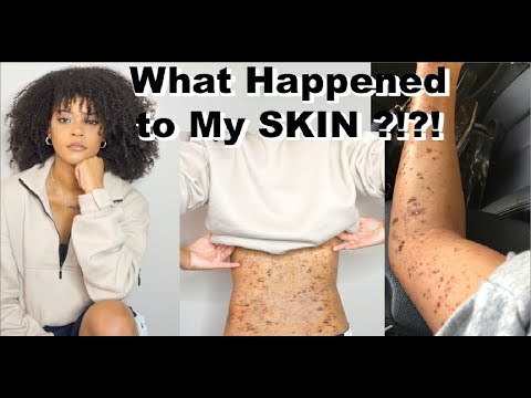 What Happened to My SKIN ???