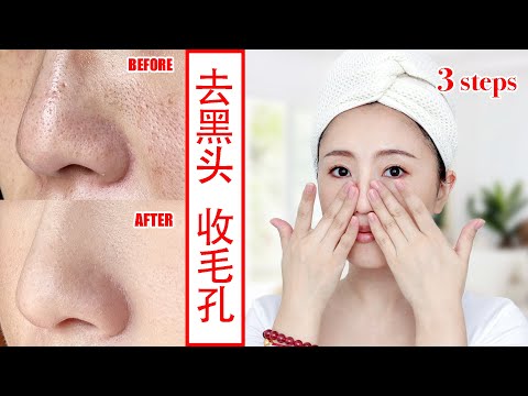 Easy 3 Steps, Remove Blackheads and Whiteheads Natural at home quickly