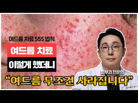 여드름 치료 포기하지마세요 "여드름 무조건 사라집니다"