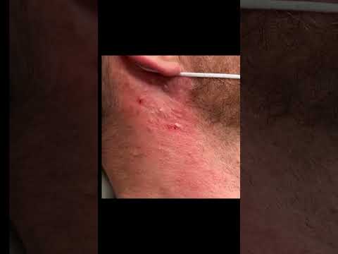 Satisfying Saucy Blackheads