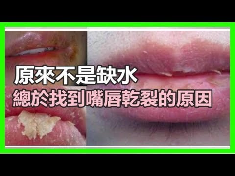 原來「嘴破口乾」不是因為水分補充不足！！！太重要了！！