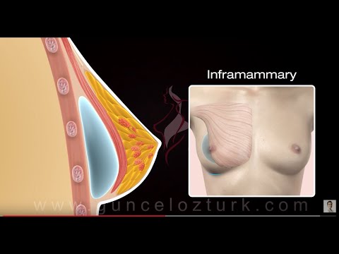 Wie erfolgt eine Brustvergrößerung? (Vergrößerung, Straffung) Güncel Öztürk M.D.