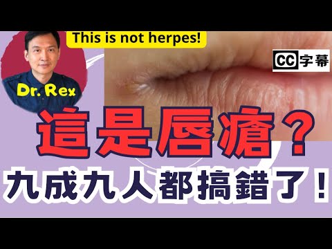 (AI中文字幕/Eng Sub)嘴角出現這種問題，其實不是唇瘡？this is not herpes!