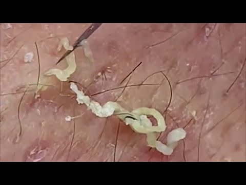 Blackheads + Whiteheads Removal