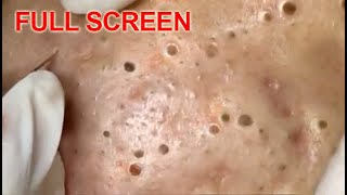 LARGE Blackheads Removal - Best Pimple Popping Videos