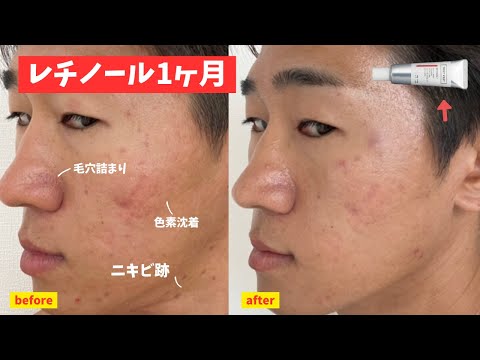 【レチノール1ヶ月経過 】効果と使い方からおすすめスキンケアの順番！【再放送】