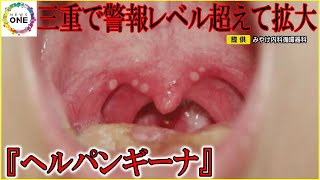 コロナ対策緩和と免疫力低下も影響か…子供中心に飛沫等で感染『ヘルパンギーナ』三重で警報レベル超えて拡大