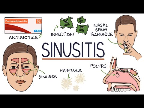 Understanding Sinusitis