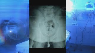 Teen Gets Phone Charger Cord Stuck in Urethra?