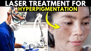 Do Lasers ACTUALLY WORK for Sun Spots, Age Spots and Hyperpigmentation?