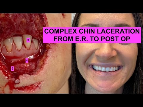 REAL PATIENTS REAL STORIES: Complex Chin Laceration Repair & Revision: From E.R. to PostOP