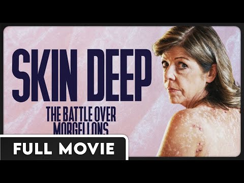 Skin Deep: The Battle Over Morgellons FULL MOVIE - Documentary, Independent