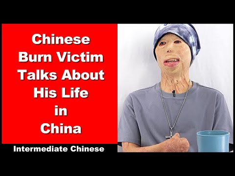 Chinese Burn Victim Talks About His Life in China - Intermediate Chinese - Chinese Conversation