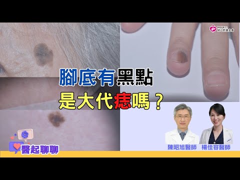 腳底有黑點是大代「痣」嗎？｜醫起聊聊