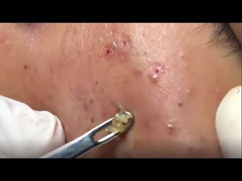 Deep Acne Removal By Expert, Milia, Acne Treatment