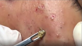 Deep Acne Removal By Expert, Milia, Acne Treatment