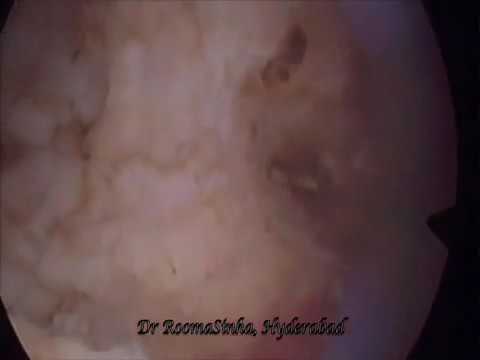 Hysteroscopic septal resection B mp4   YouTube 360p